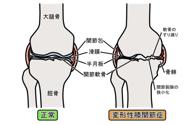 変形性ひざ関節症の図