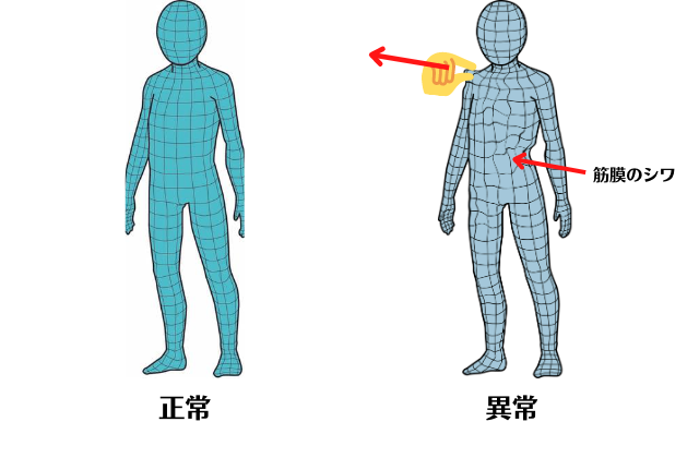 筋膜の歪みをあわらしている図