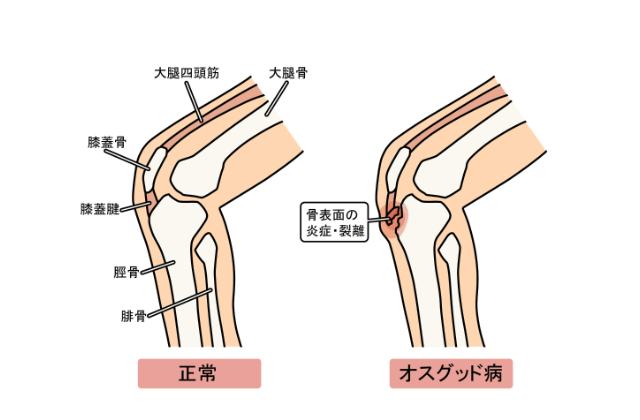 オスグッド病