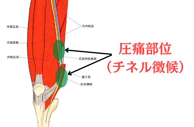 伏在神経圧痛部位