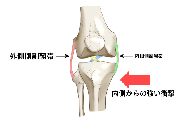 外側側副靱帯