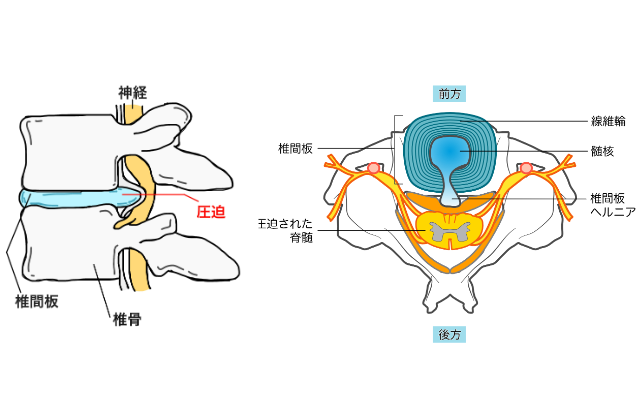 腰椎ヘルニア